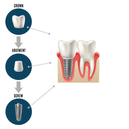 Dental Implants in Kinnelon